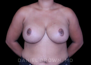 Breast Lift - Case 153 - After
