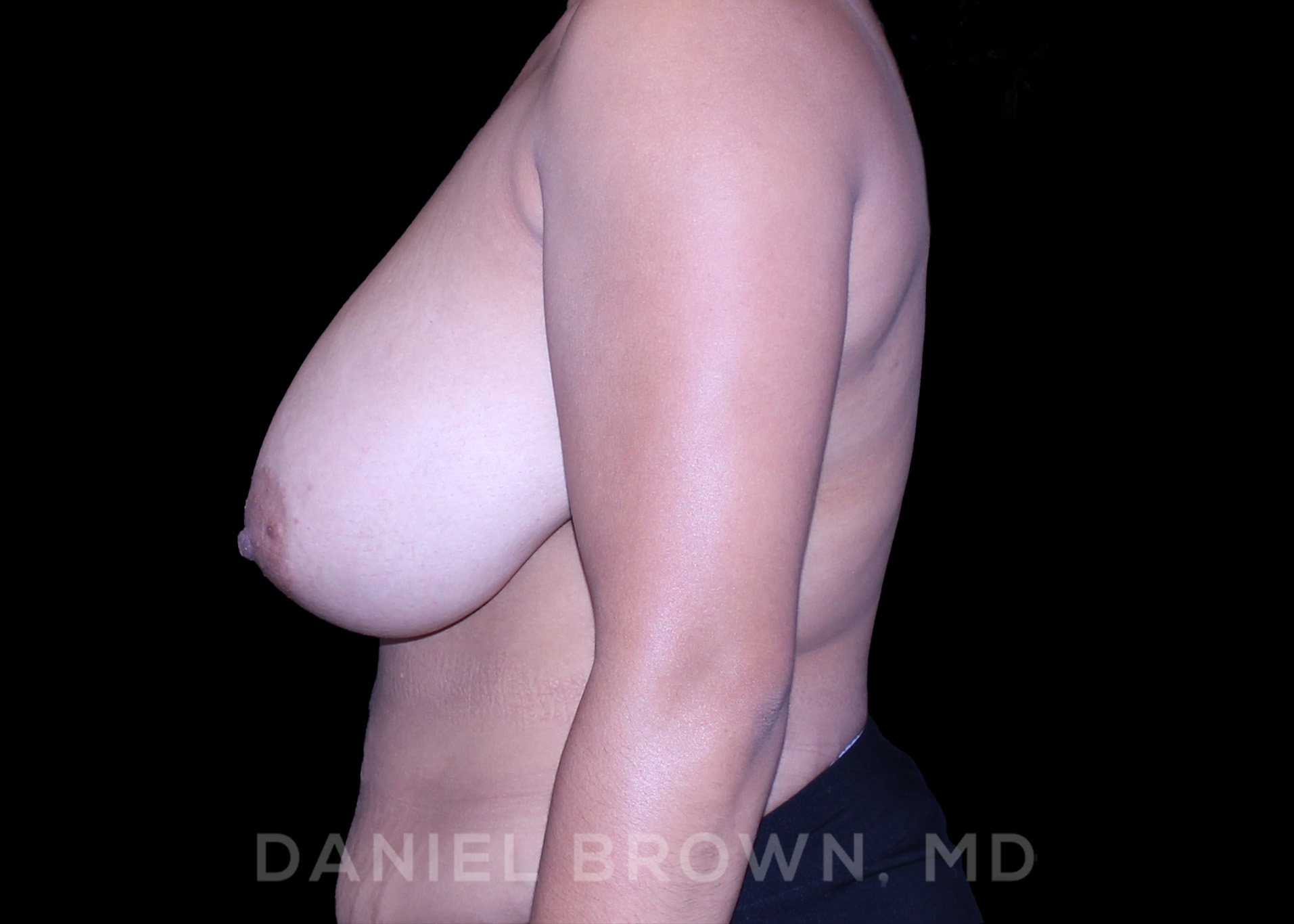 Breast Lift Patient Photo - Case 153 - before view-