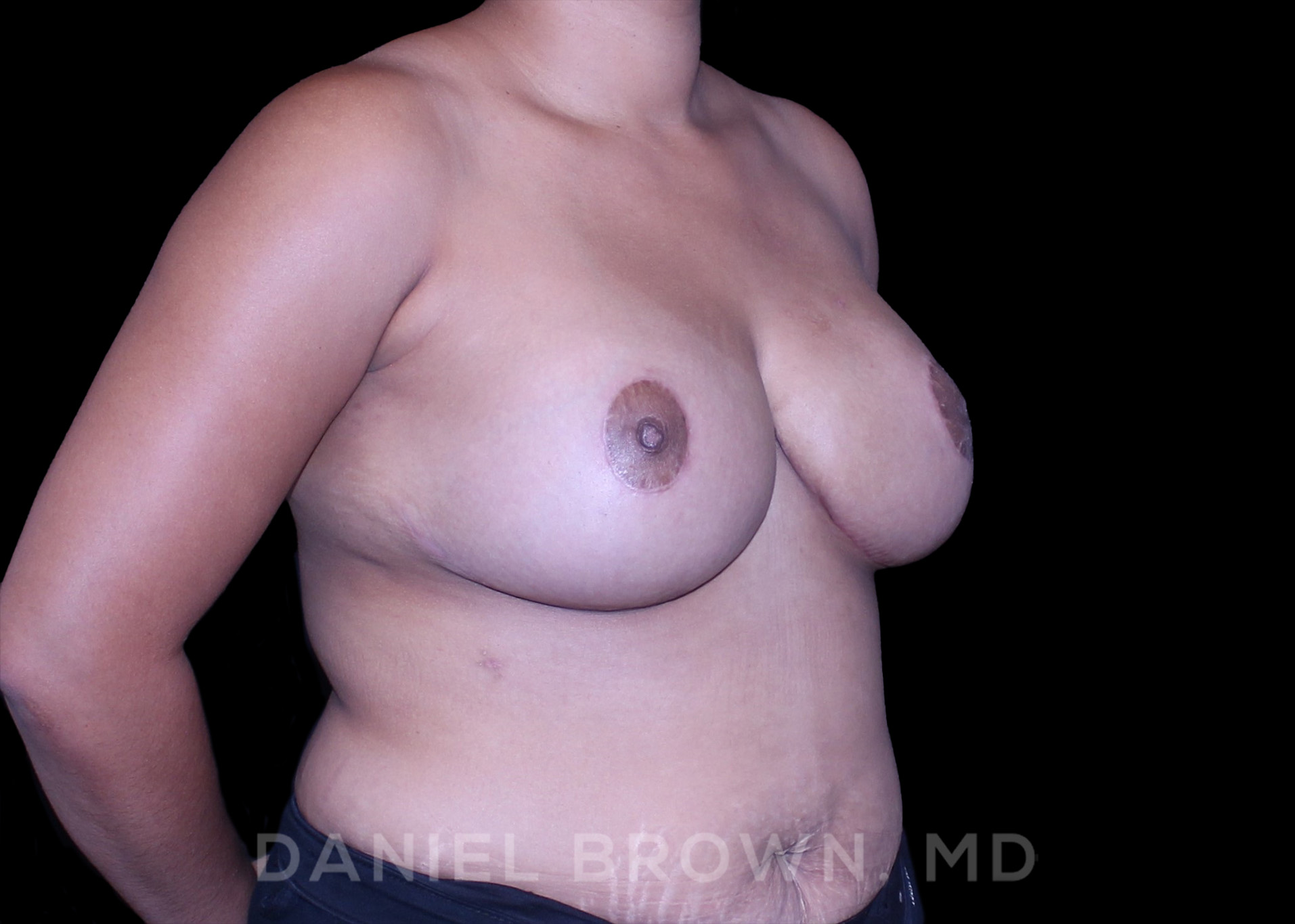 Breast Lift Patient Photo - Case 153 - after view