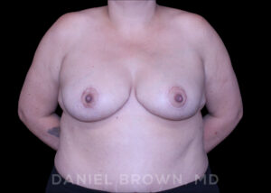 Breast Lift - Case 164 - After