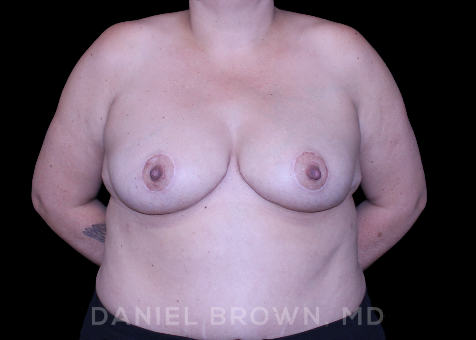 Breast Lift Patient Photo - Case 164 - after view-0