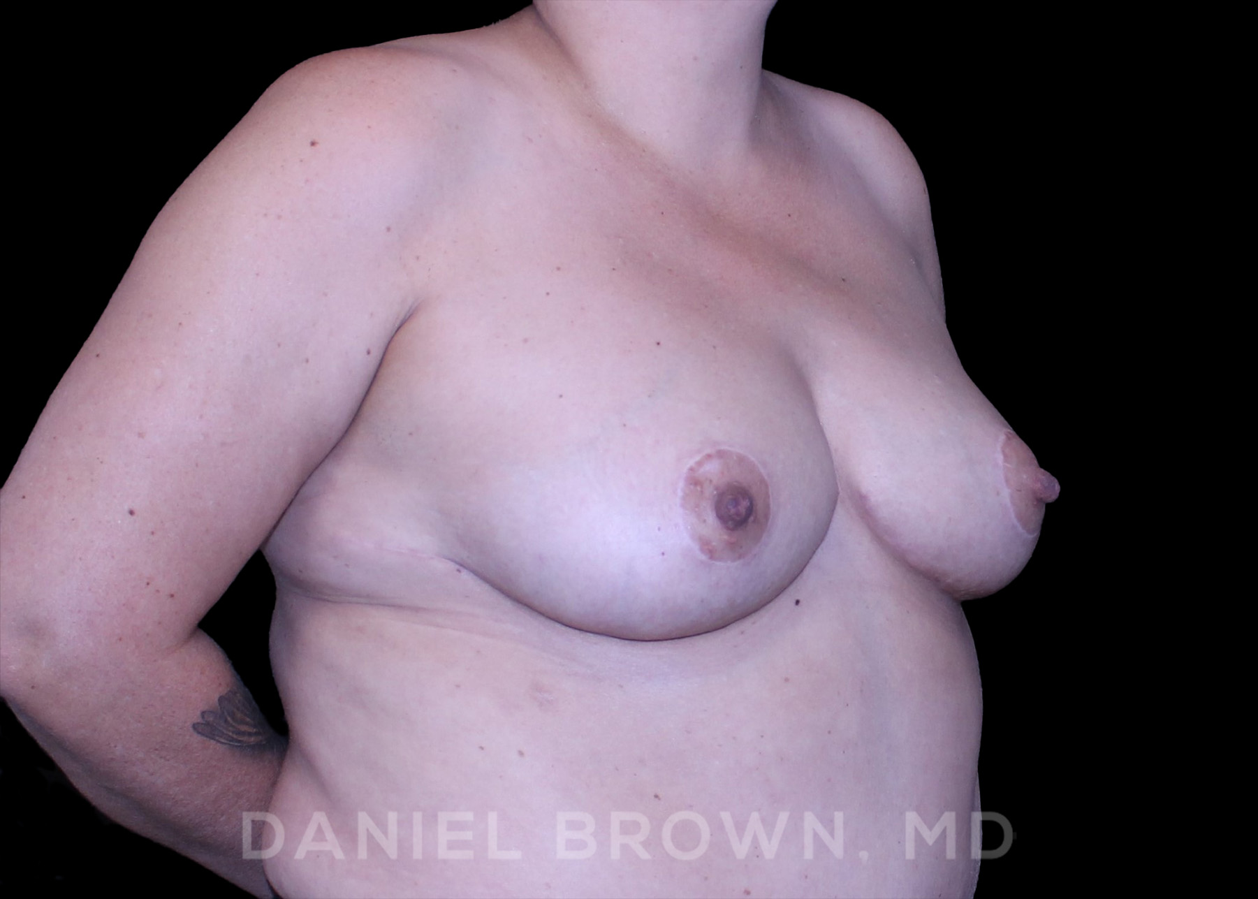 Breast Lift Patient Photo - Case 164 - after view-2