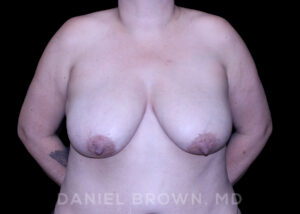 Breast Lift - Case 164 - Before