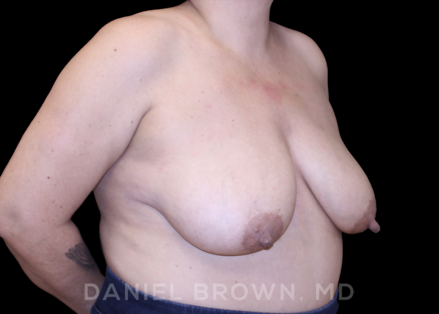 Breast Lift Patient Photo - Case 164 - before view-