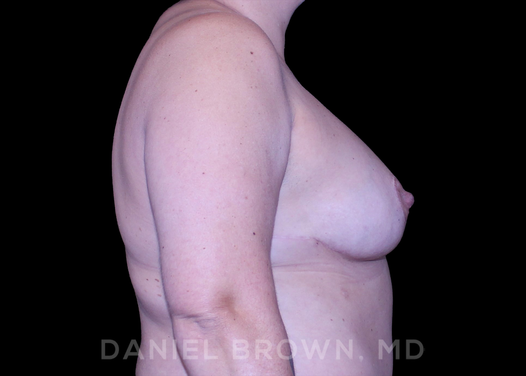 Breast Lift Patient Photo - Case 164 - after view-4