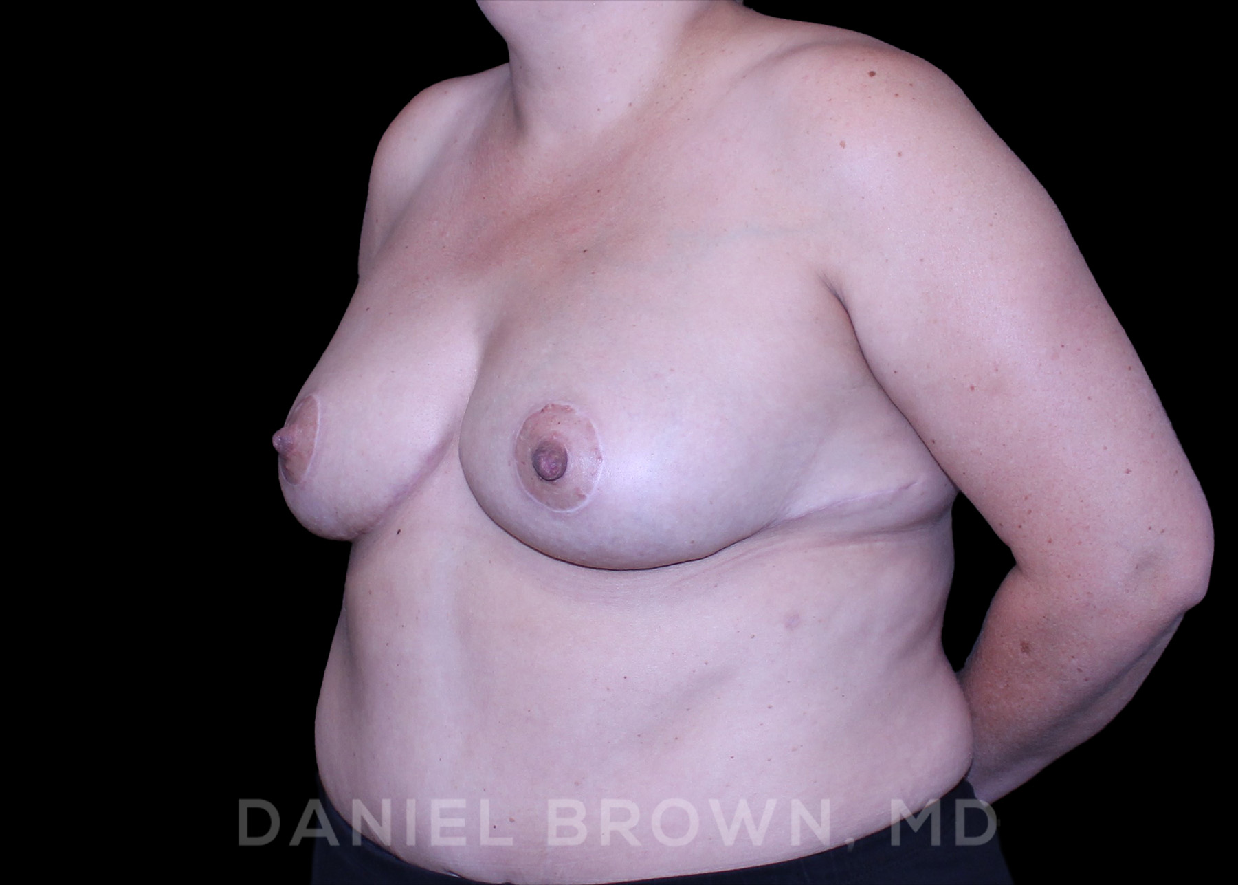 Breast Lift Patient Photo - Case 164 - after view-1