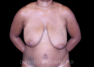Breast Lift - Case 210 - Before