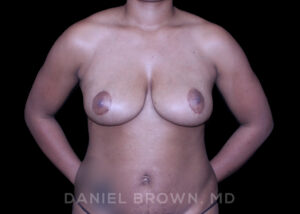Breast Lift - Case 210 - After