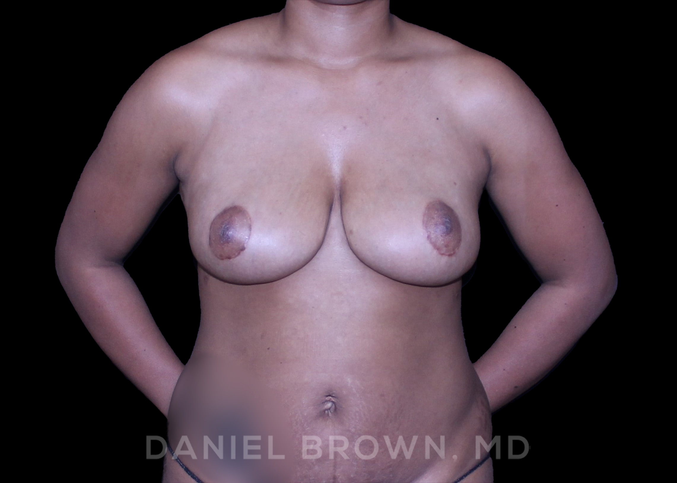 Breast Lift Patient Photo - Case 210 - after view-0