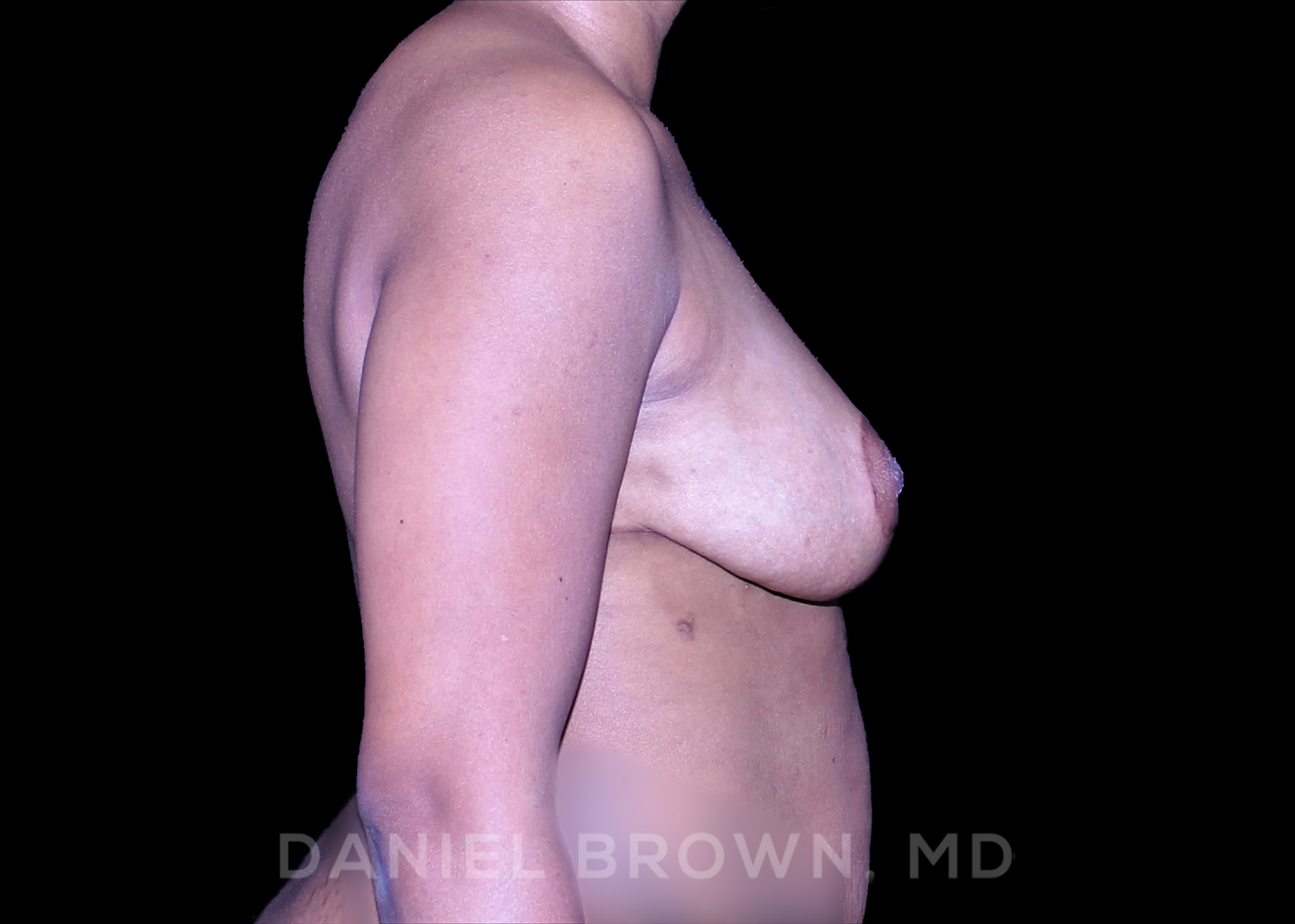 Breast Lift Patient Photo - Case 210 - after view-4