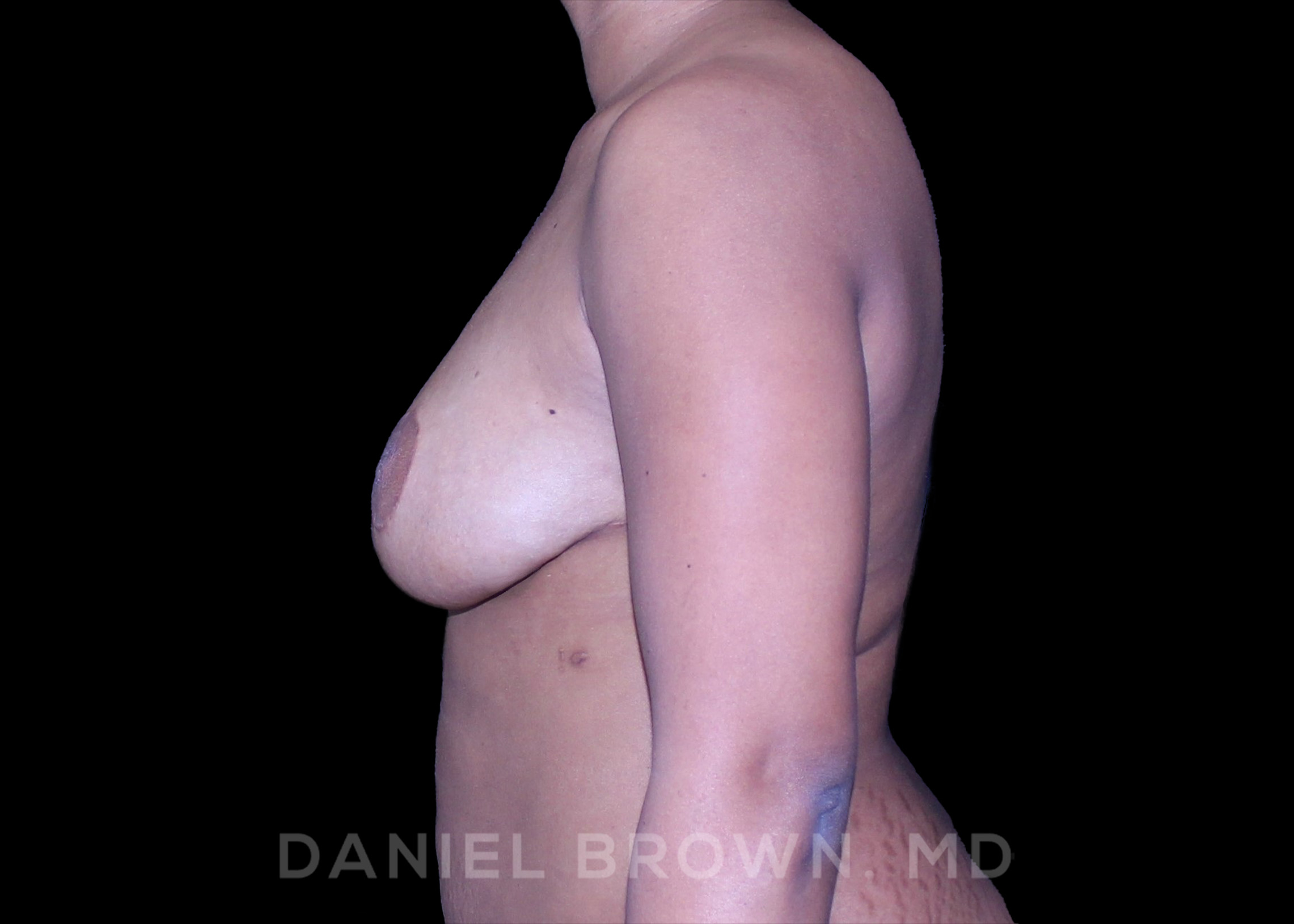 Breast Lift Patient Photo - Case 210 - after view-3