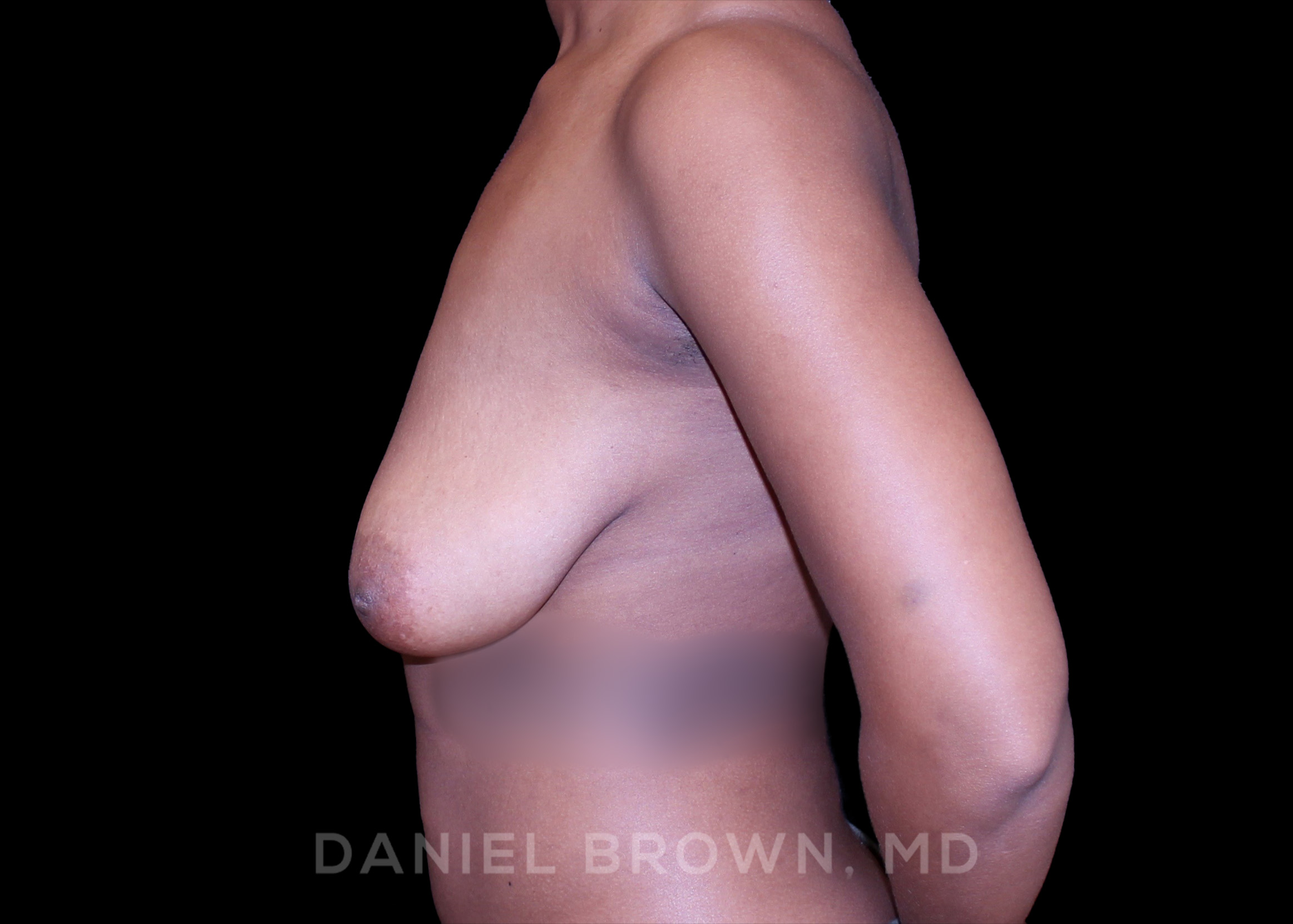 Breast Lift Patient Photo - Case 221 - before view-2
