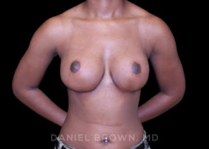 Breast Lift - Case 221 - After