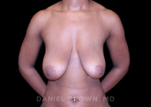 Breast Lift - Case 221 - Before