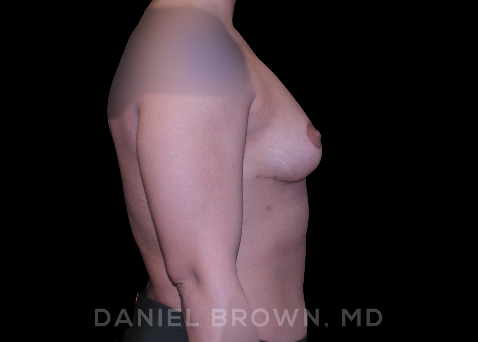 Breast Lift Patient Photo - Case 228 - after view-4