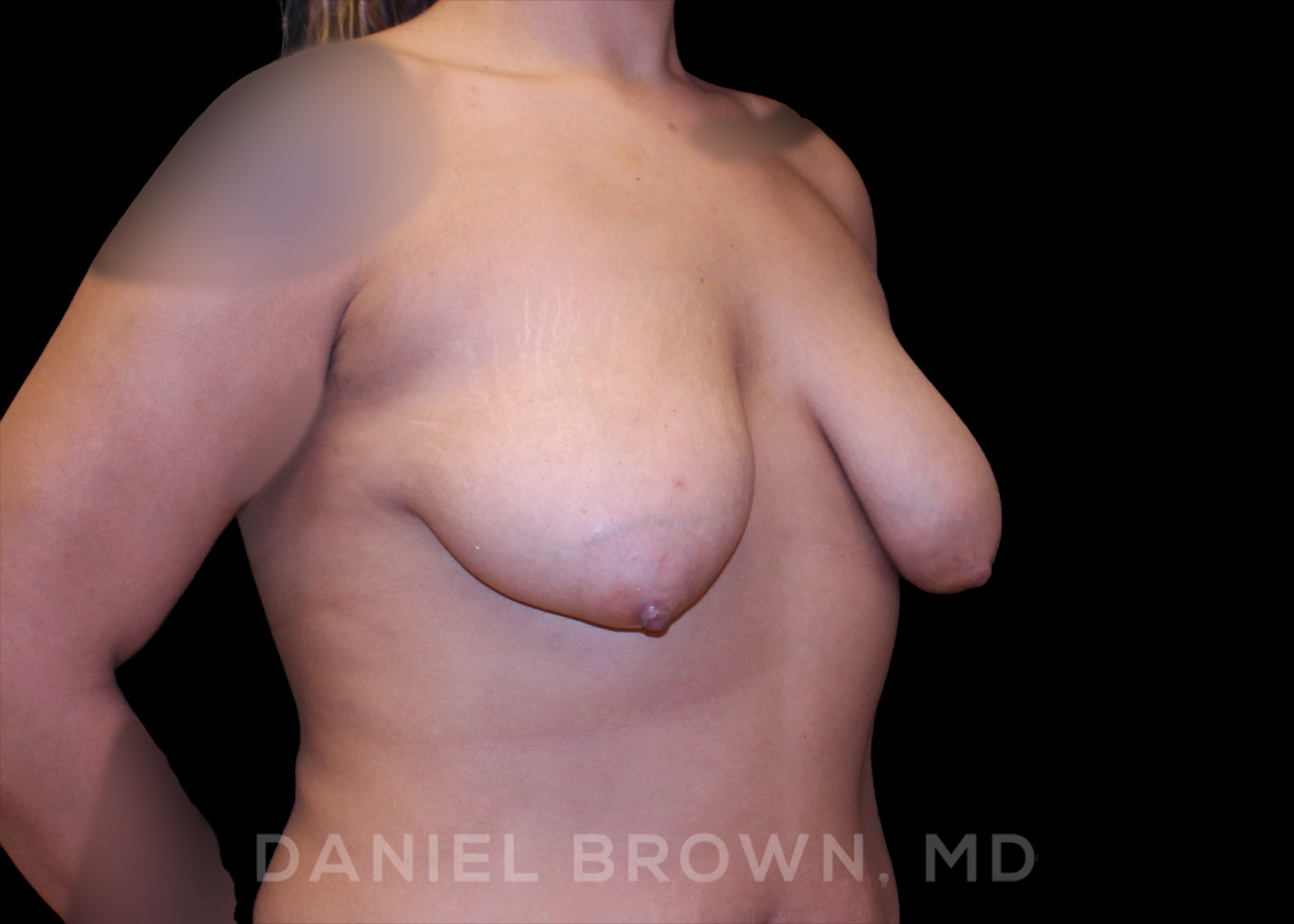 Breast Lift Patient Photo - Case 228 - before view-