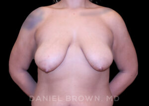 Breast Lift - Case 228 - Before
