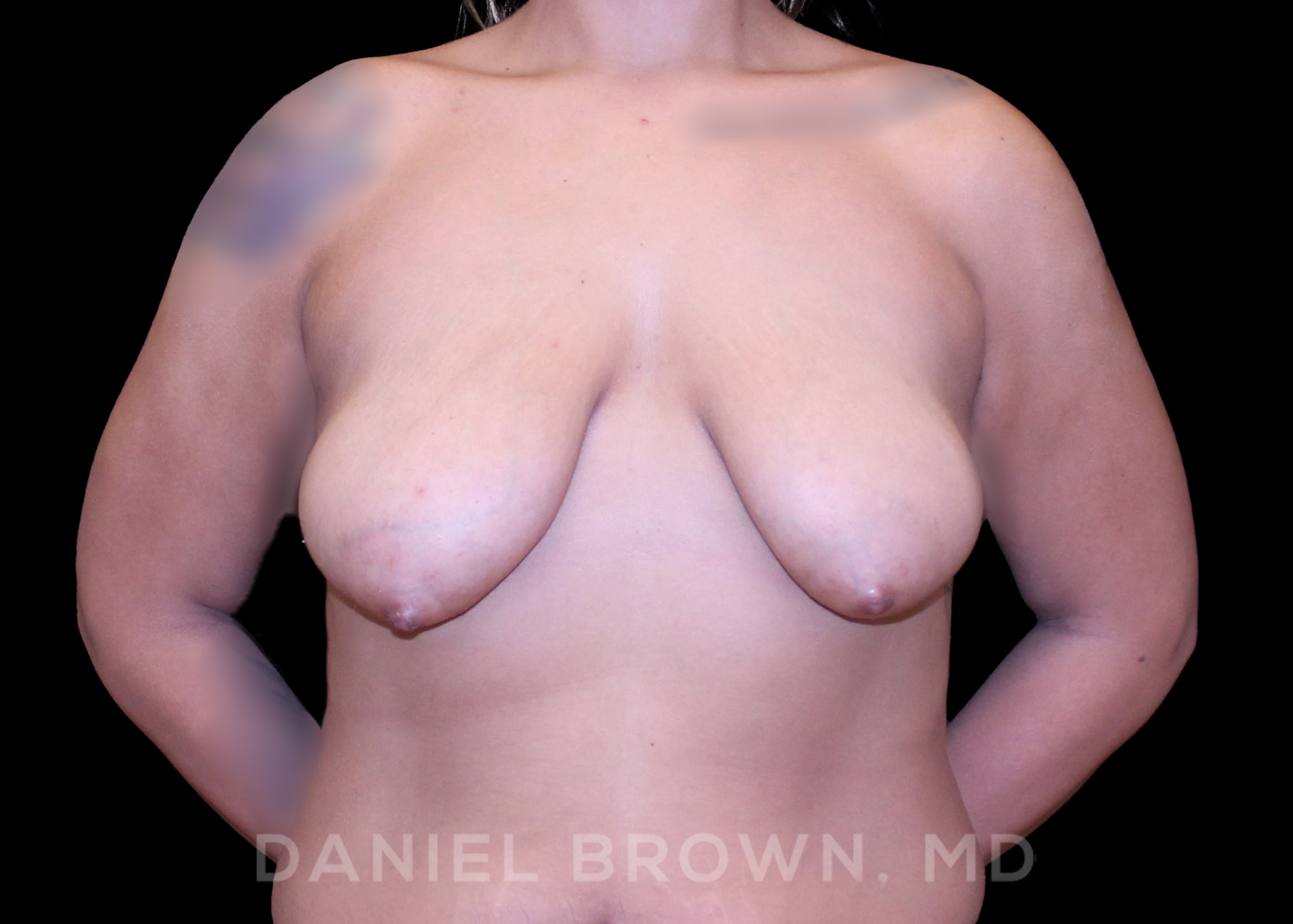Breast Lift Patient Photo - Case 228 - before view-