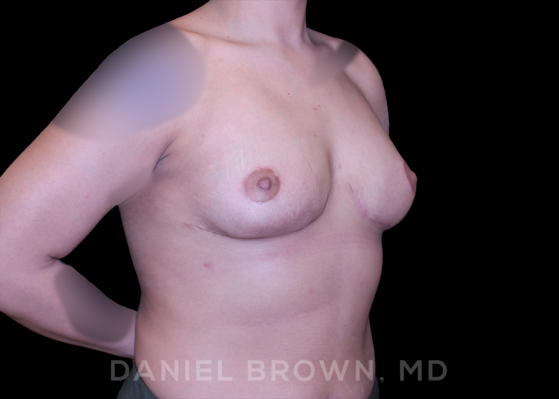 Breast Lift Patient Photo - Case 228 - after view-2