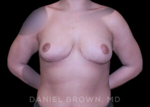 Breast Lift - Case 228 - After