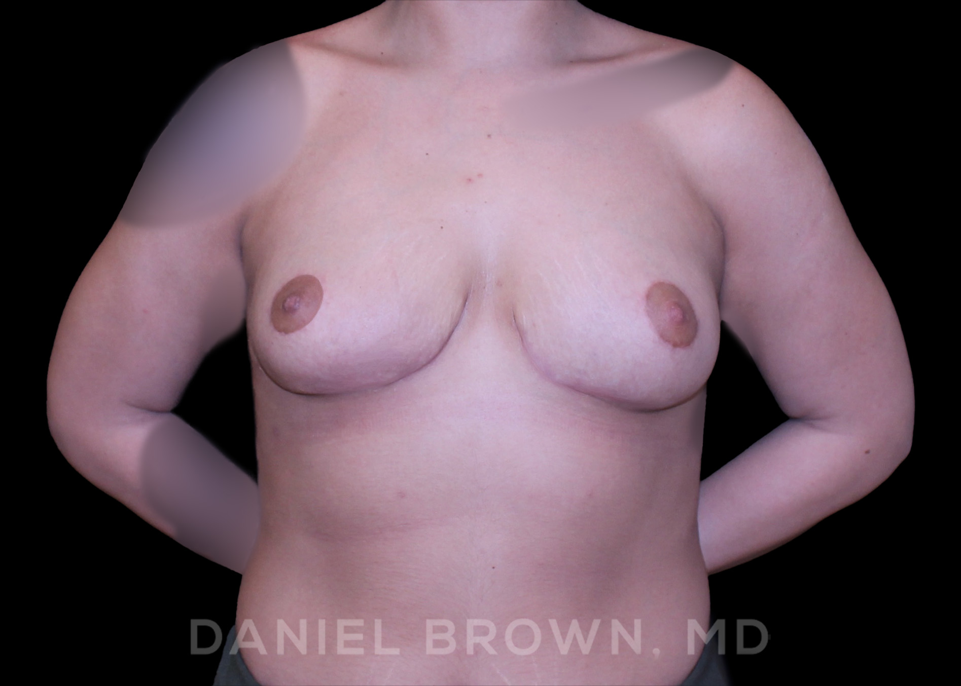 Breast Lift Patient Photo - Case 228 - after view-0