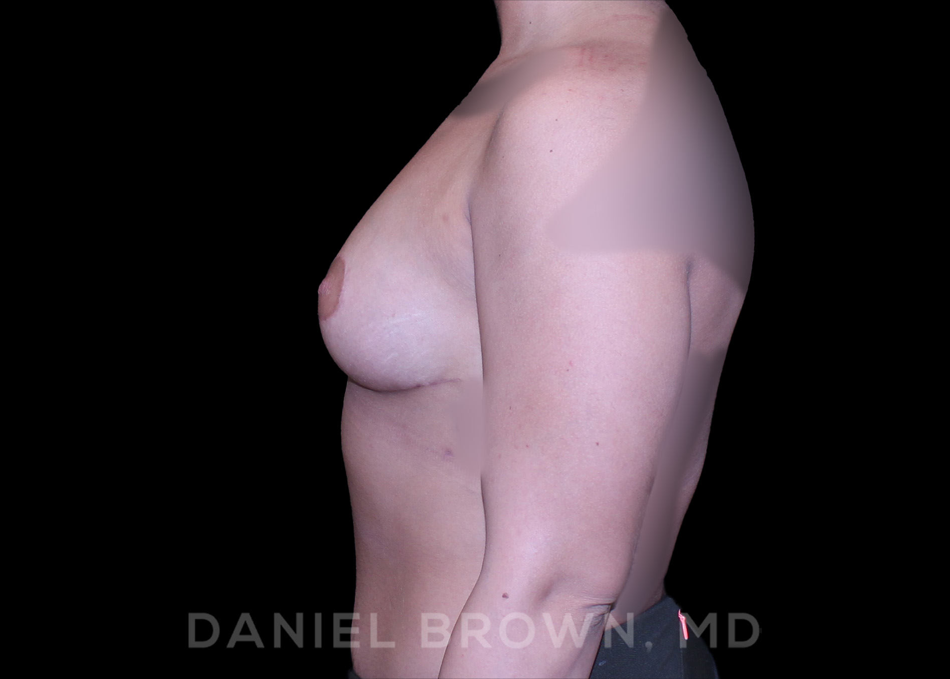 Breast Lift Patient Photo - Case 228 - after view-3