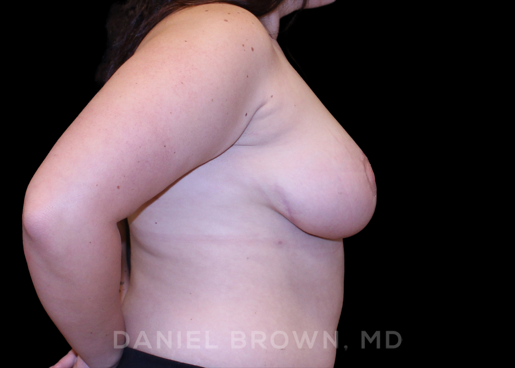 Breast Lift Patient Photo - Case 239 - after view