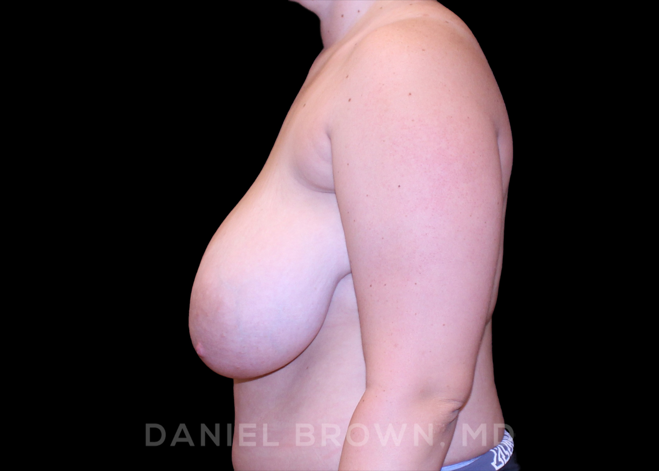 Breast Lift Patient Photo - Case 239 - before view-1