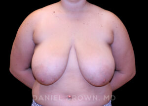 Breast Lift - Case 239 - Before