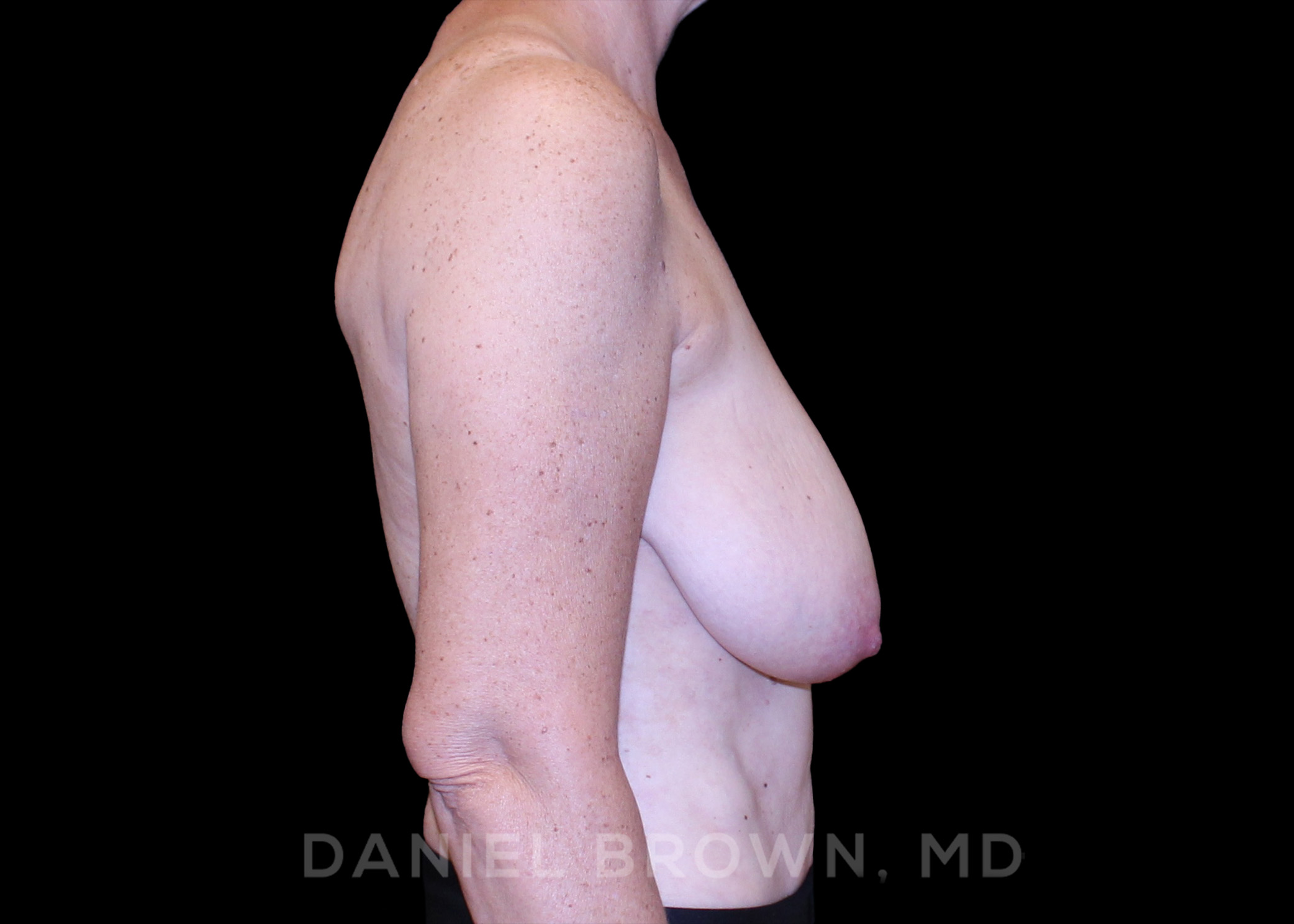 Breast Lift Patient Photo - Case 246 - before view-
