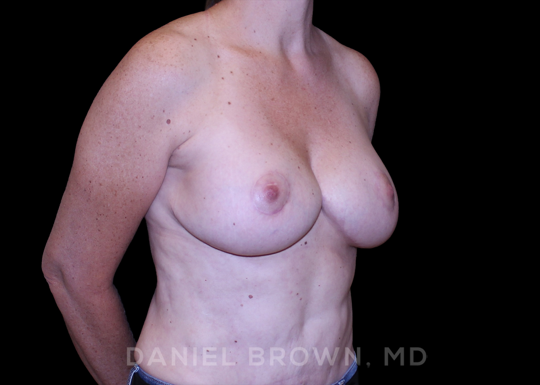 Breast Lift Patient Photo - Case 246 - after view-2