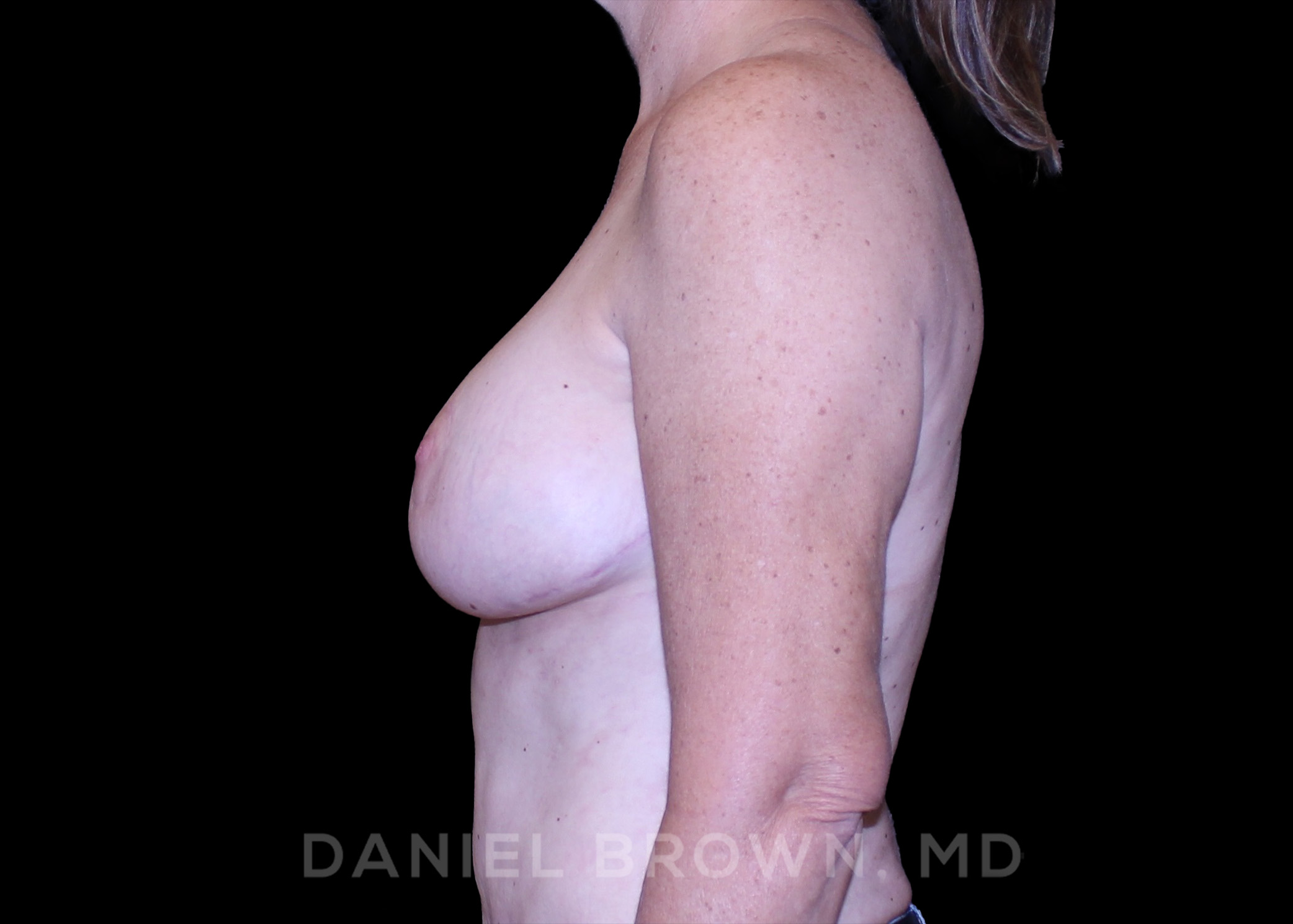 Breast Lift Patient Photo - Case 246 - after view-3