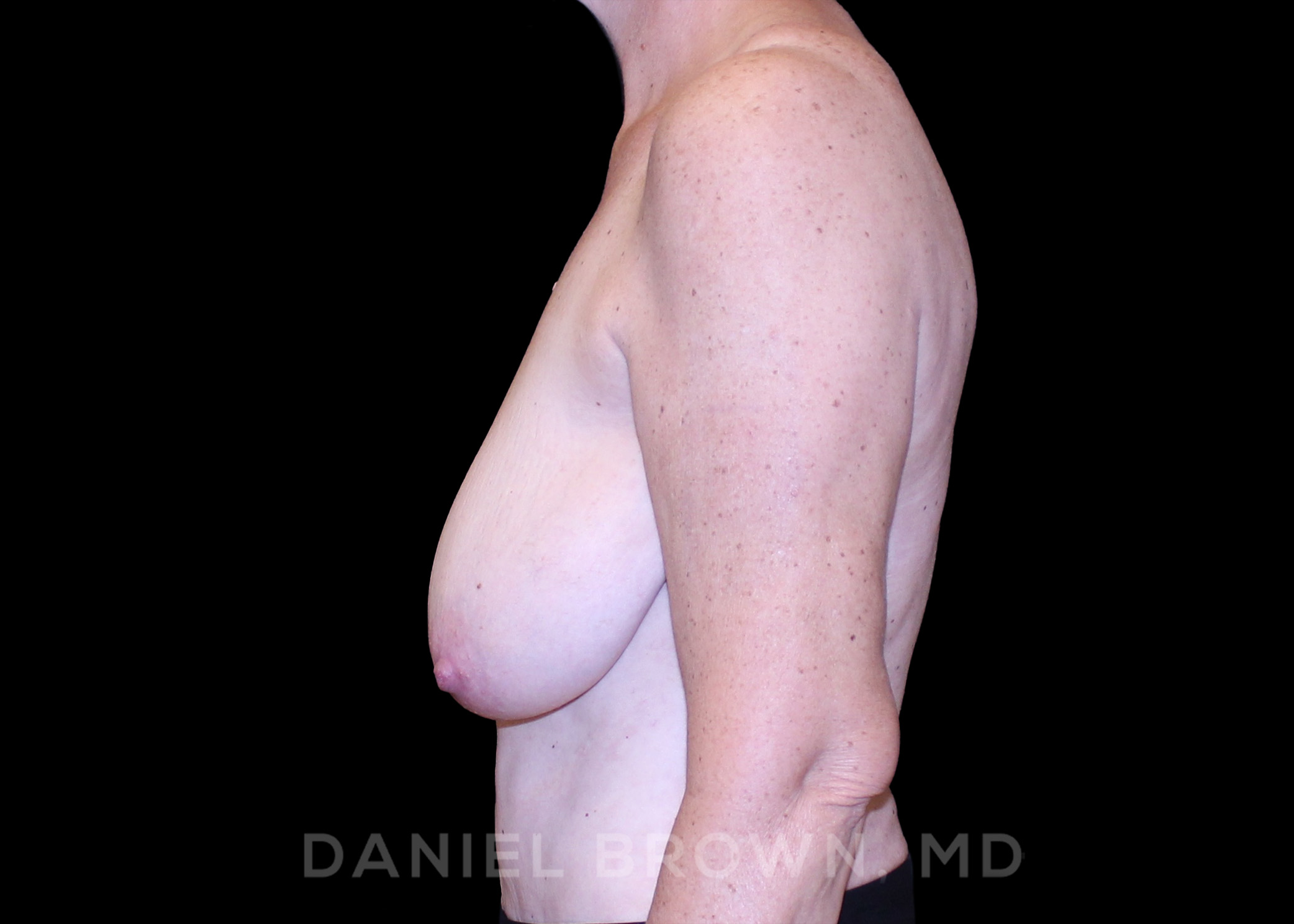 Breast Lift Patient Photo - Case 246 - before view-
