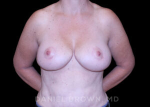 Breast Lift - Case 246 - After