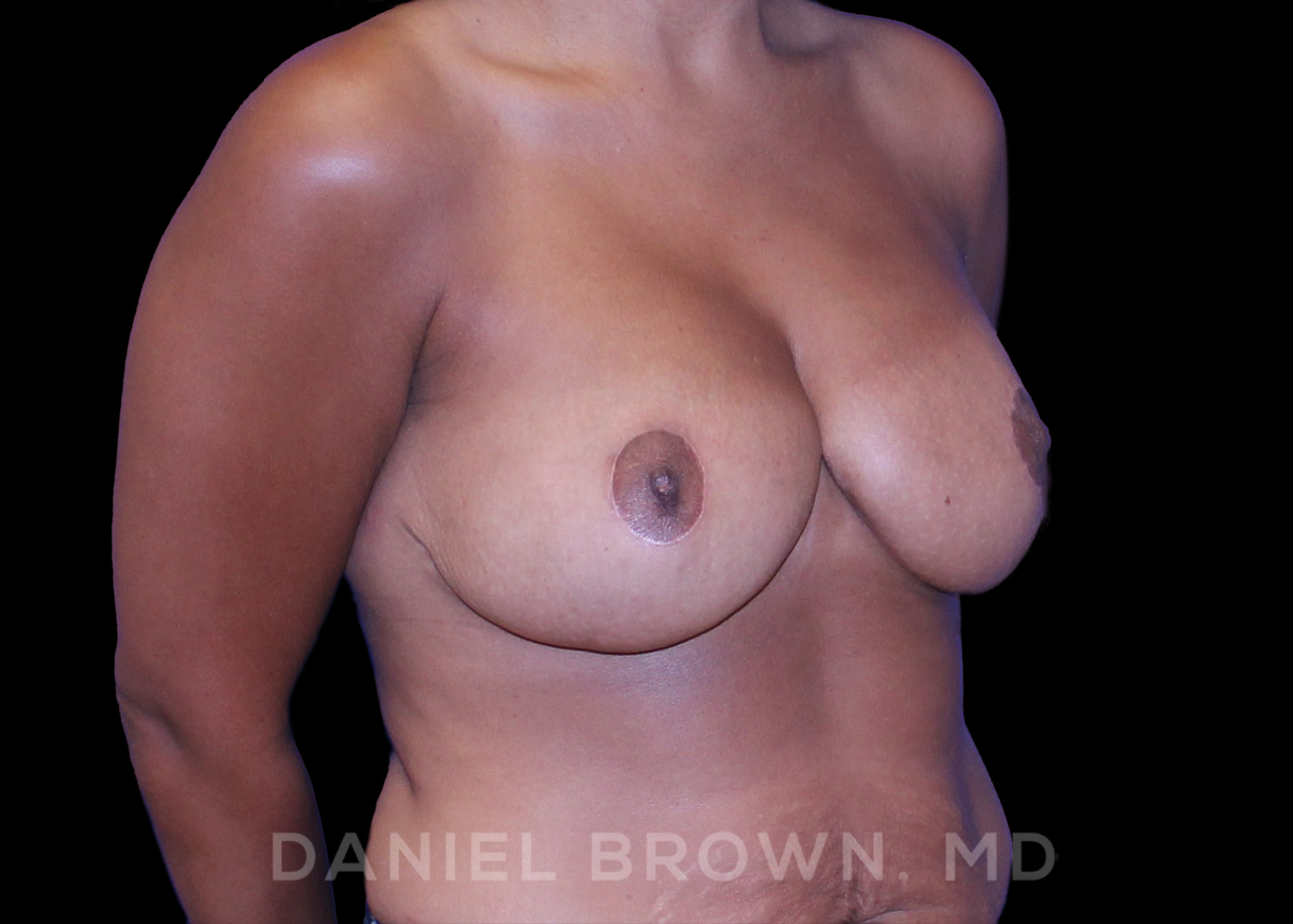 Breast Lift Patient Photo - Case 257 - after view