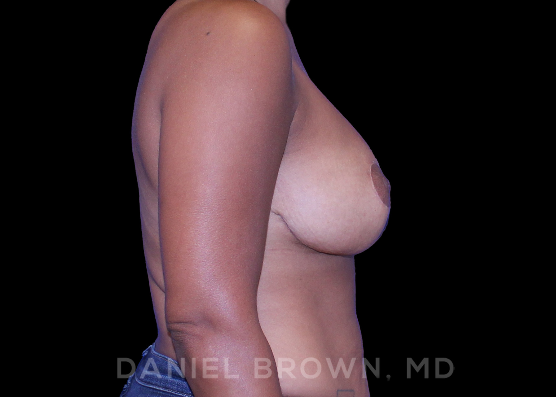 Breast Lift Patient Photo - Case 257 - after view-4