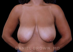 Breast Lift - Case 257 - Before