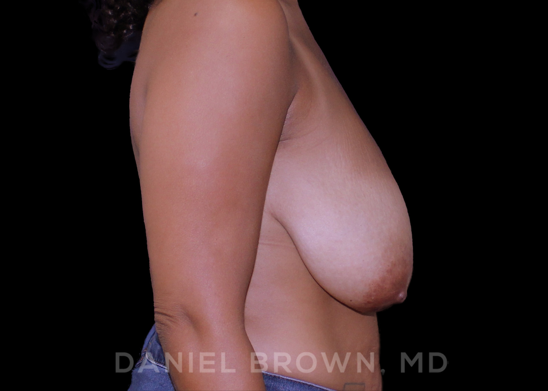 Breast Lift Patient Photo - Case 257 - before view-4