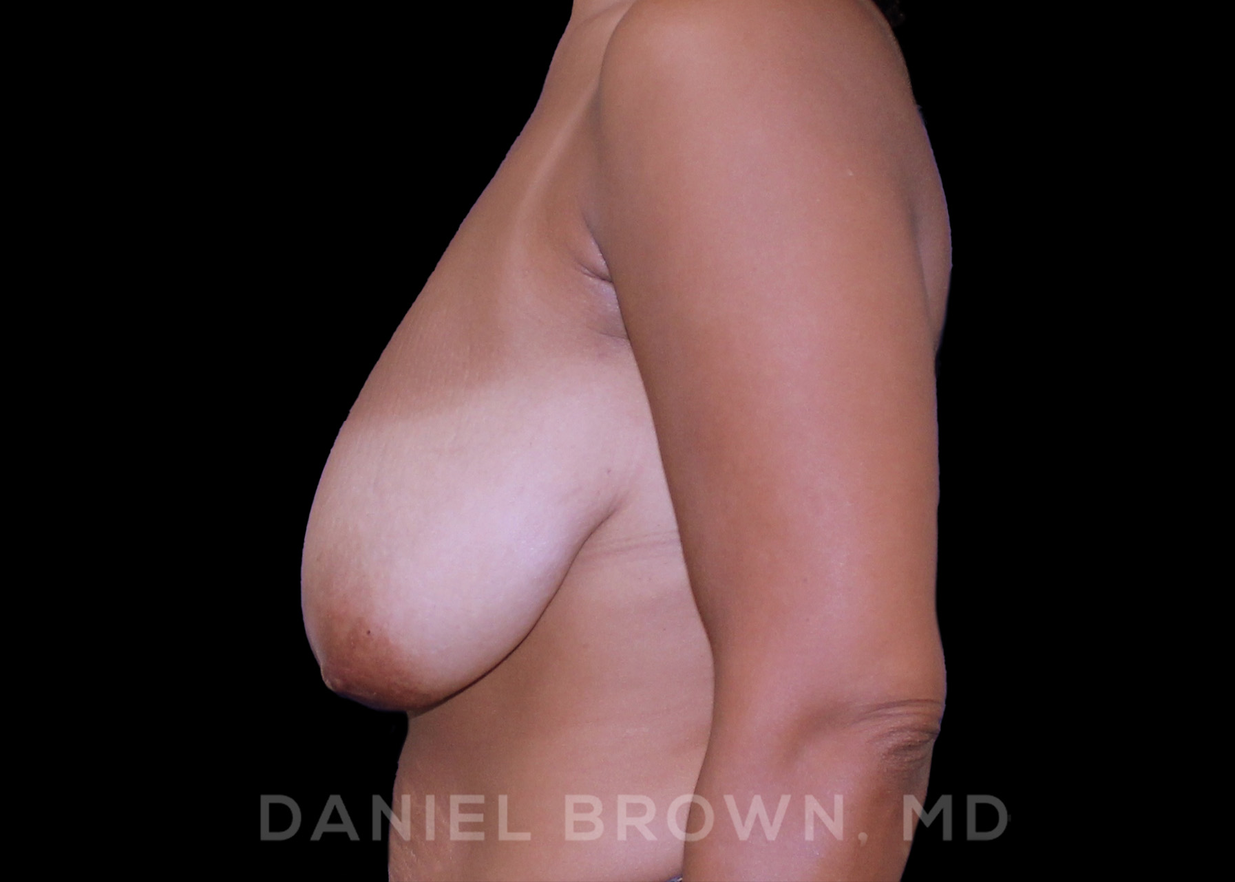 Breast Lift Patient Photo - Case 257 - before view-3