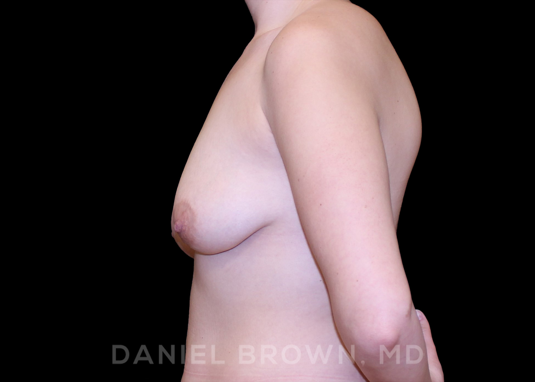 Breast Lift Patient Photo - Case 268 - before view-3