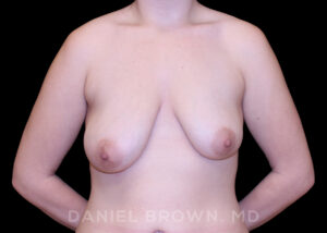 Breast Lift - Case 268 - Before