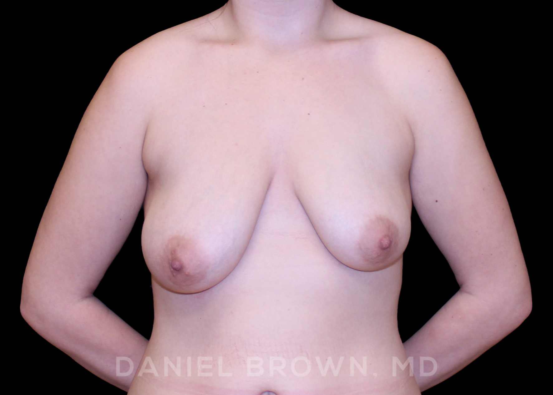 Breast Lift Patient Photo - Case 268 - before view-