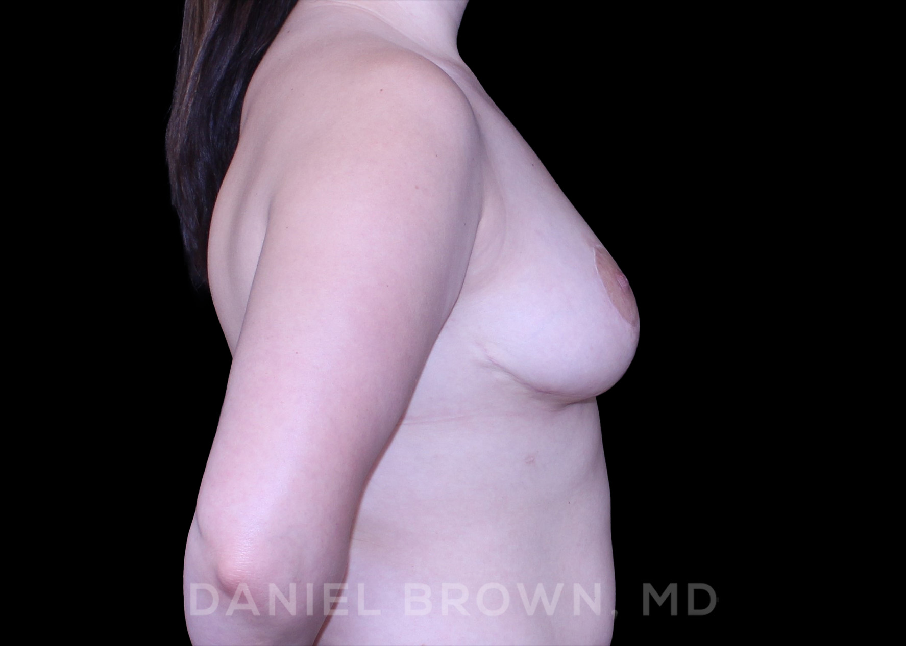 Breast Lift Patient Photo - Case 268 - after view