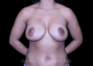Breast Lift - Case 279 - After