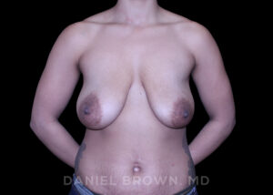 Breast Lift - Case 279 - Before