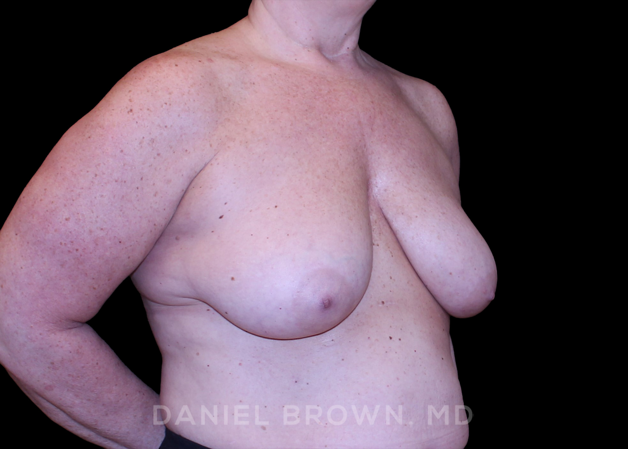 Breast Lift Patient Photo - Case 290 - before view-