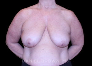 Breast Lift - Case 290 - Before