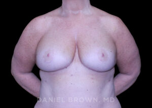Breast Lift - Case 290 - After