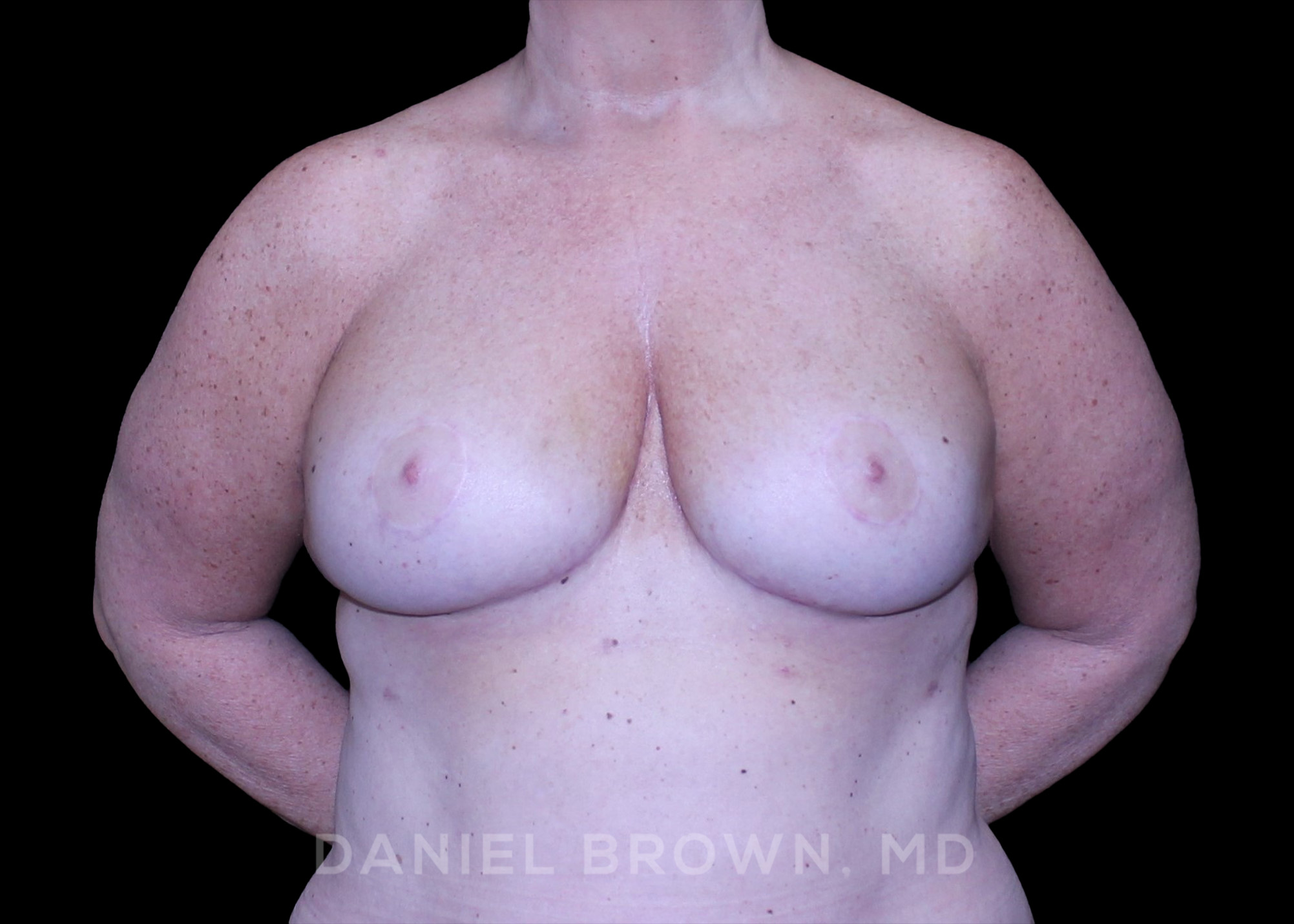 Breast Lift Patient Photo - Case 290 - after view-0