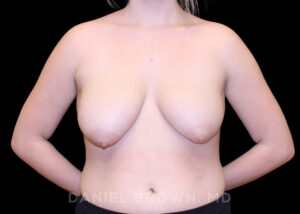 Breast Lift - Case 301 - Before